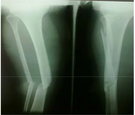 Tableau VI : Traitements initial des fractures en fonction de l’état cutané 