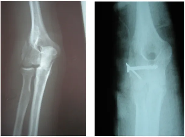 Fig. 8 (Cas 2) : fractures du condyle externe 