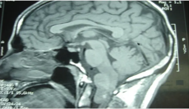 Figure 11 : Image IRM préopératoire, coupe sagittale, séquence pondérée T1,   Montre un kyste entérogénique du FM