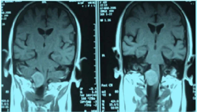 Figure 14: Image  IRM préopératoire, coupe coronale, séquence T1,   montre un neurinome du FM