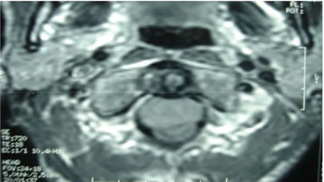 Figure 16 : Image IRM préopératoire,  coupe axiale, séquence T1, montre un kyste  entérogénique