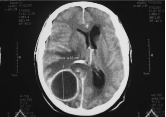 Figure 4 : Image scanogrqphique cérébrale en coupe axiale avec injection de produit de  contraste, objectivant un volumineux abcès pariétal droit avec œdème périlésionnel
