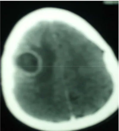 Figure 6 : Image scanographique cérébrale en coupe axiale avec injection de produit de contraste  montrant une lésion parenchymateuse pariétale droite hypodense avec prise de contraste 