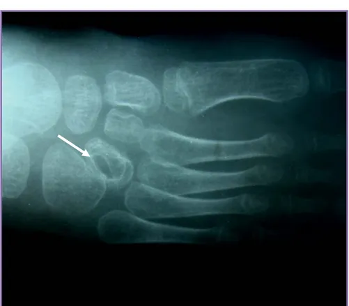 Figure N°2 : Radiographie du pied droit  