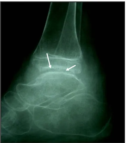 Figure N°4 : Radiographie de la cheville droite de profil révélant Une irrégularité   des berges articulaires de la tibio-astragalienne (Observation N°3) 