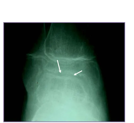 Figure N°5 : Radiographie de la cheville droite de face  