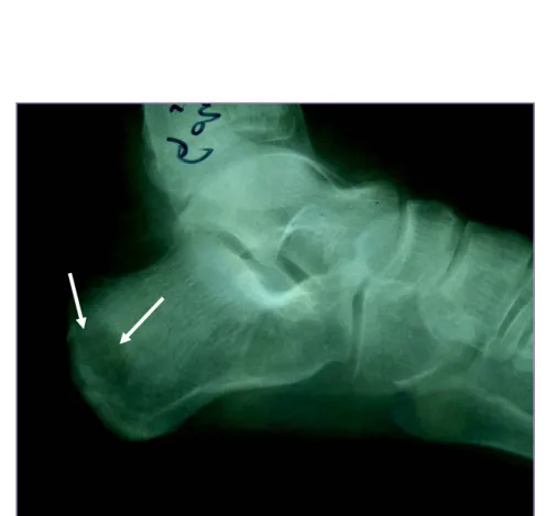 Figure N°6: Radiographie du pied gauche  
