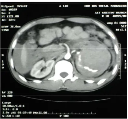 Fig. 13 : TDM abdominale montrant un éclatement rénal gauche avec lésion  pédiculaire et  volumineux hématome de la loge rénale