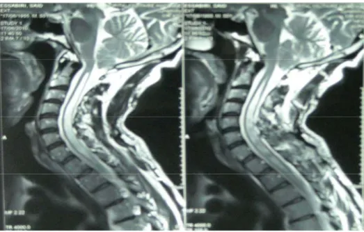 Figure 2 : Coupe sagittale d’une IRM de la charnière cervico-occipitale en séquence T2  Malformation de Chiari I avec cavité syringomyélique cervicale secondaire et hyper-lordose cervicale 