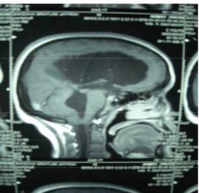 Figure 4 : IRM encephalique en coupe sagittale en séquence pondérée T1 montrant une hydrocephalie  tetraventriculaire sur malformation de Chiari I avec cavité syringomyélique cervicale 