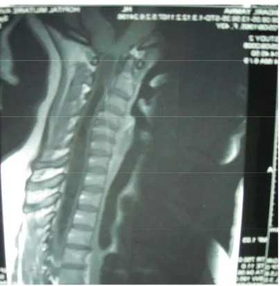 Figure 5 : IRM de la charnière cervico-occipitale coupe sagittale en séquence T1 : Chiari I  dilatation de V4  Syringomyélie cervico dorsale 