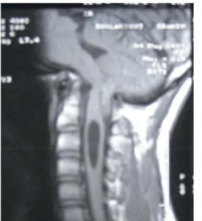 Figure 7 : IRM de la charnière cervico-occipitale,coupe sagittale, en séquence pondérée T1 :   malformation de Chiari I associée à une cavité syringomyélique cervicale 