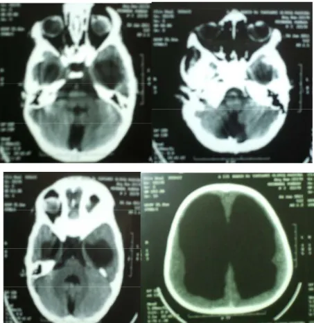 Figure 10 :TDM cérébrale : malformation de dandy walker  associé à une hydrocéphalie tétra - -entriculaire 