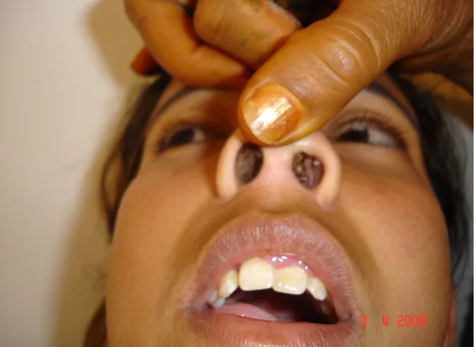 Figure 6 : Aspect clinique de la tuberculose nasale. 