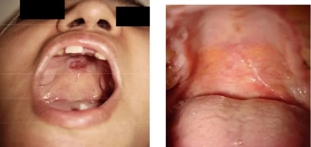 Figure 10: aspect endobuccal 3 mois après la chirurgie, puis reconstruction ad-integrum du                                                        palais dur 2 ans après