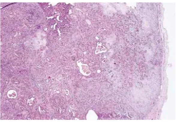 Figure 13: prolifération tumorale faite de contingent épithéliale et chondro-myxoide. La tumeur  est cernée par une capsule d’épaisseur irrégulière (Grossissement X 40, coloration HE)