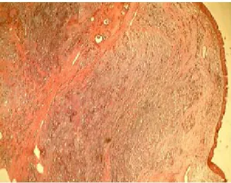 Figure 27: Aspect de muqueuse de type respiratoire dont le chorion est le siège d’une 