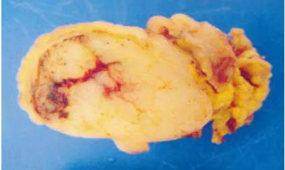 Figure 4 : Coupe macroscopique d’une tumeur  stromale de l’intestin grêle à croissance mixte,  exo- et endophytique