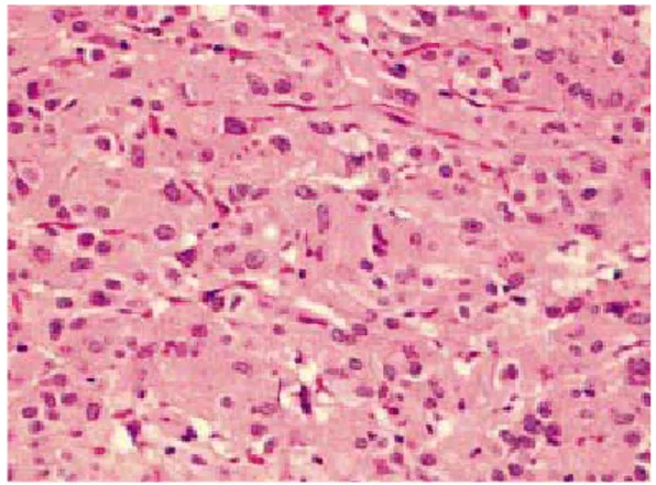 Figure 5 : Aspect histologique d’une tumeur  stromale constituée de cellules fusiformes.