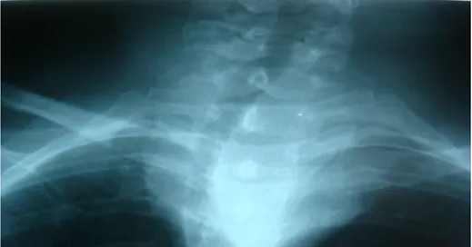 Fig 19: Radiographie thoracique montrant une volumineuse   Tuméfaction  cervicale responsable d’une compression de 
