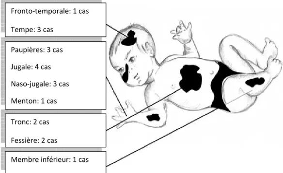 Figure n°3 : répartition des naevus selon la localisation