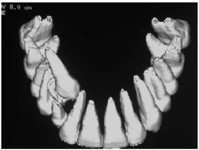 Figure 12 : Reconstruction 3D dentaire (16).  1-3-L’ imagerie par résonance magnétique : (16) (17) 