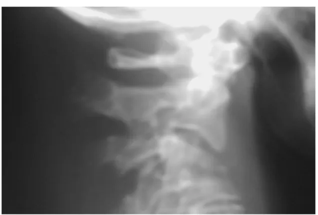 Figure 23 :Radiographie du rachis cervical (profil) montrant pincement discal avec image  d’ostéolyse C3-C4 .