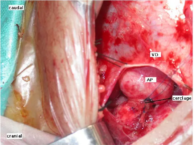 Figure 6: Vue opératoire d’un cerclage de l’artère pulmonaire en cas d’un CAV 