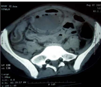 Figure n° 13: coupe axiale tomodensitométrique réalisée chez  un patient âgé de 17 ans