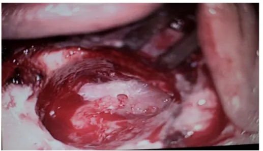 Figure 13: Tympanoplastie en technique ouverte 