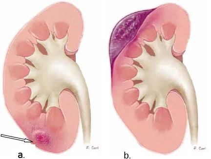 Figure 2 :   a.  contusion rénale (flèche)                 b. hématome sous capsulaire    Grade II (figure 3):  