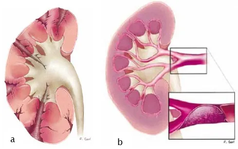 Figure 6 :  a. Fragmentation complète du rein ;               b. Avulsion du pédicule rénal