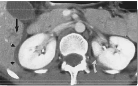 Figure 19 : lacération parenchymateuse moins d’1cm 