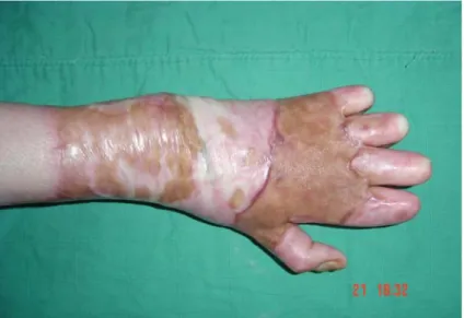 Fig. 13 : Résultat final après cicatrisation complète de la greffe de peau totale 