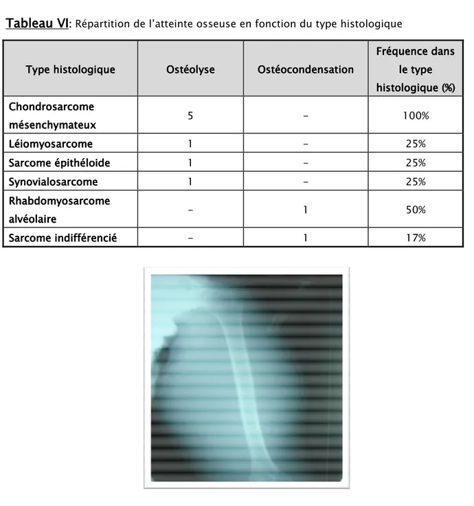 Figure    20 20 20::::  20 Radiographie standard d’un liposarcome du bras gauche  La figure n°20  objective l’aspect d’un liposarcome du bras gauche à la radiographie  standard