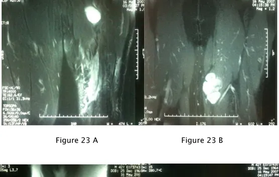Figure 23    :::: IRM d’une récidive de liposarcome myxoide de la cuisse gauche 