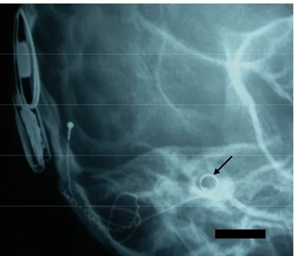 Figure 12 12 12 12    : Radiographie standard post chirurgicale - incidence Stenvers :   Les électrodes en place (flèche)