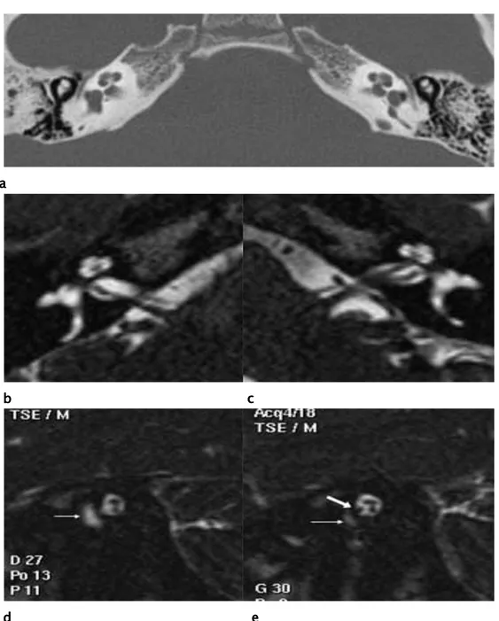 Figure 33 igure 33 igure 33 igure 33    :  :  :  : Sténose du canal pour le nerf cochléaire (TDM)- agénésie du nerf cochléaire (IRM) [85]