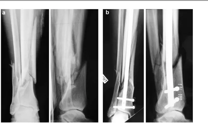 Figure n° 7: Fracture distale des deux os de la jambe. Exemple de cal vicieux. (a) radiologie initiale  de face