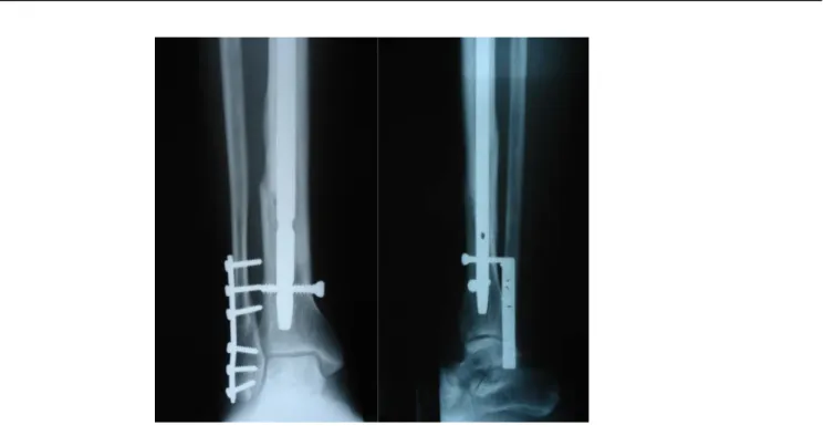 Figure n° 12: Radiographie de contrôle du même patient faite 18 semaines après le traitement