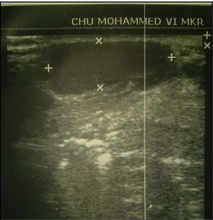 Figure 8 : échographie cervicale montrant une image kystique oblongue hypo-échogène bien limitée avec renforcement postérieur 