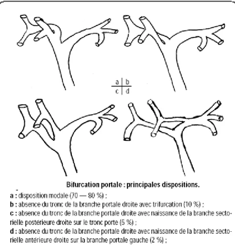 Figure 9 : Schéma illustrant les principales variantes  anatomiques de la bifurcation portale [3]