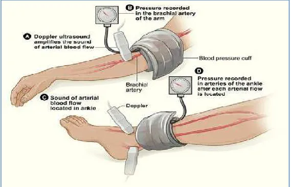 Figure  re  re  re 1 1 1 1 Technique de mesure de l ’ IPS par sonde Doppler 