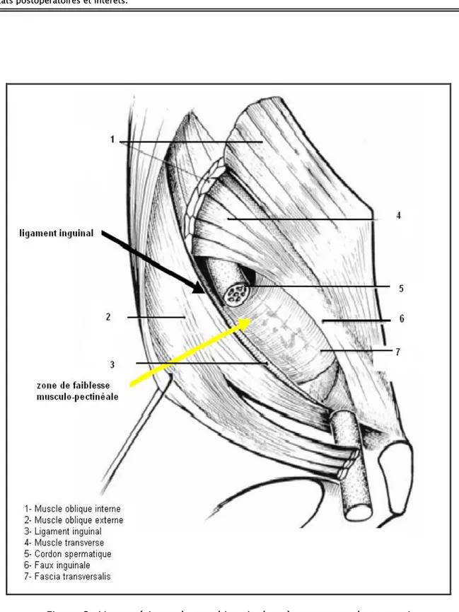 Figure 6 : Vue antérieure du canal inguinal après ouverture de sa paroi   antérieure et section partielle du muscle oblique interne