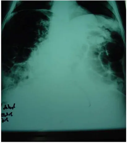 Figure 3: Radiographie de l’abdomen sans préparation montrant des             multiples clartés gazeuses en inter-hépato-diaphragmatique droit  