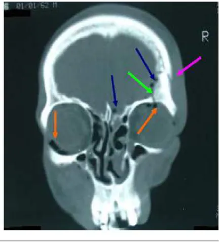 Figure n° 7 : TDM en coupe coronale montrant une fracture frontale droite ( ր ր ր ր )  étendue au toit de l’orbite homolatéral ( րր րր ) avec PNO ( րրրր ) et pneumo-orbite( ր)ր)ր)ր)