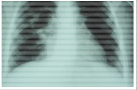 Figure    8 8 8 8:  :  :  : radiographie de thorax mettant en évidence une pneumopathie  postopératoire 