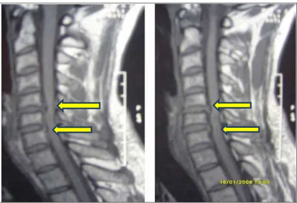 Figure n°8: IRM coupe sagittale pondérée T1 montrant une hernie discale cervicale bi- - - -étagée étagée étagée étagée     C5C6 et C6C7.