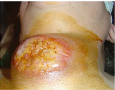 Figure 8 8 8: Image montrant une infiltration cutanée chez une femme porteuse  8 d’un carcinome anaplasique