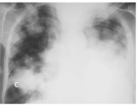 Figure 11 11 11 11: Radiographie thoracique standard de face montrant : C C C C : des opacités  macronodulaires reparties aux 2 hémi-champs pulmonaires avec pleurésie 